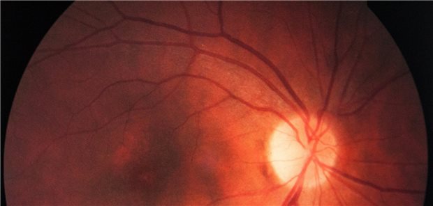 Makulaödem. Patienten mit diabetischem Makulaödem haben nun Aussicht auf Therapieintervalle von bis zu 16 Wochen.
