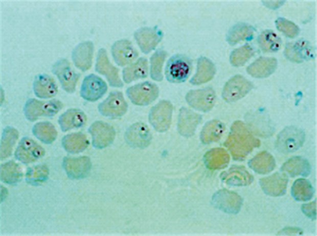Harmloses, aber gelegentlich auch Riskantes im Gepäck Malaria tropica. Hohe Parasitämie mit bereits einem erwachsenen Schizonten.