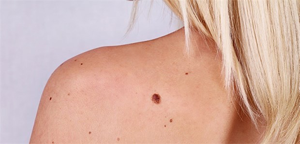 Maligne oder nicht? Mitttels kombinierter PET/CT lässt sich nach Expertenmeinung diese Frage leichter klären, vor allem bei möglichen Rezidiven.