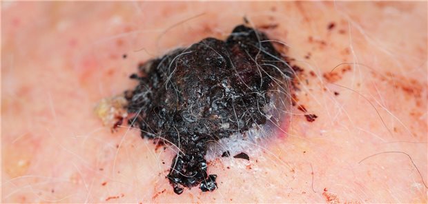 Malignes Melanom: Die Prognose über die restliche Lebenszeit von betroffenen Patientinnen und Patienten ist ein klinisch relevantes und leicht zu interpretierendes Maß, welchen Einfluss der Hautkrebs auf das Überleben hat.
