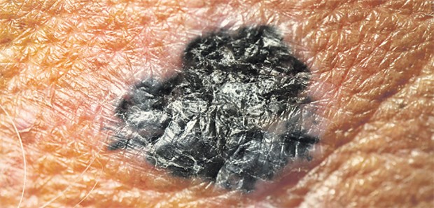 Malignes Melanom: Durch zwei Wirkstoffe mit unterschiedlichen Angriffspunkten wird das progressionsfreie Überleben verlängert.