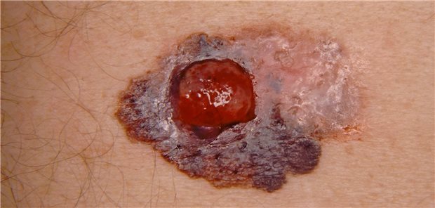 Malignes Melanom. Neue Therapien verbessern die Prognose davon betroffener Patienten.