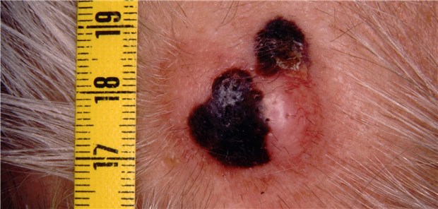 Malignes Melanom der Kopfhaut: Von den Melanom-Patienten, bei denen ein lokoregionale Rezidiv exzidiert wurde, blieb jeder Zweite bis zwei Jahre nach der Diagnose in Remission.