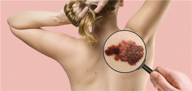 Malignes Melanom im Fokus: Patienten mit einem Melanom mit unbekanntem Primarius weisen prognostisch ungünstige Eigenschaften auf als Patienten mit fortgeschrittenem Melanom mit bekanntem kutanem Primarius.