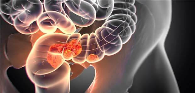 Malignome verhindern oder zumindest früh erkennen: Ziel der Kontrollkoloskopien bei CED.