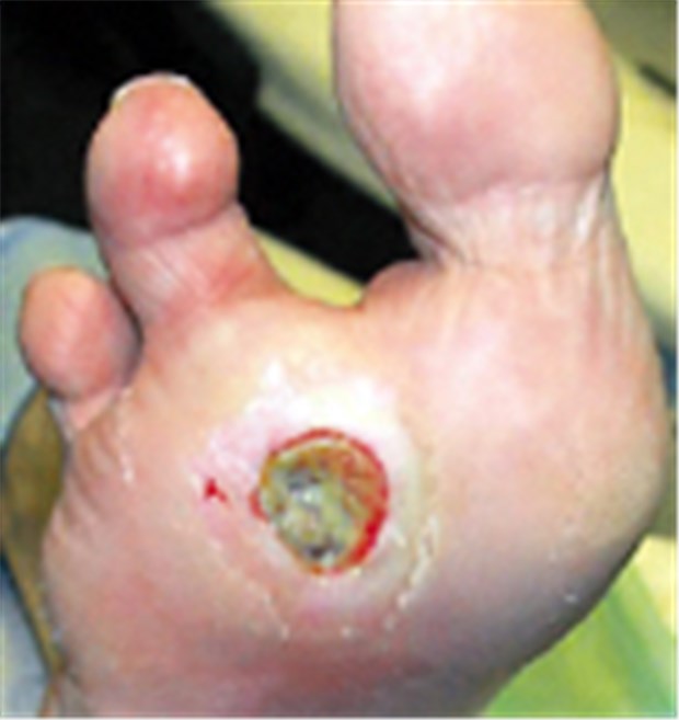 Malum perforans. Klassisches Ulkus an Prädilektionsstelle vorwiegend neuropathischer Genese. Zustand nach Amputation DII und DV.