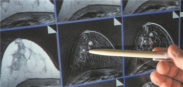 Mamma-Karzinom: Trans-Männer haben im Vergleich zu Cis-Frauen ein deutlich niedrigeres Erkrankungsrisiko.