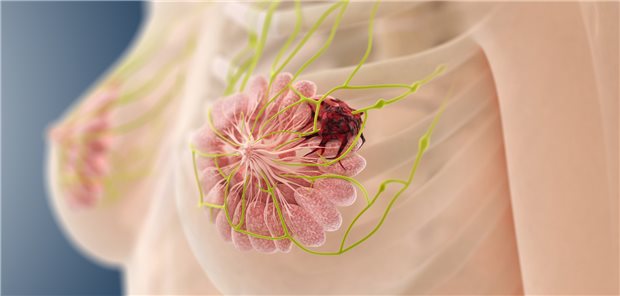 Mammakarzinom: Bei ausgewählten Patientinnen mit pathologischer Komplettremission nach neoadjuvanter Chemotherapie ist der Verzicht auf eine Operation wohl möglich.