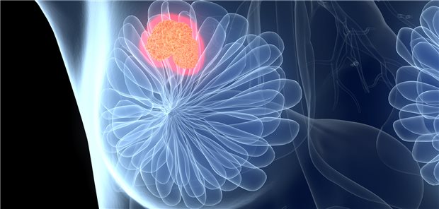 Mammakarzinom: Eine minimalinvasive Op kann eine praktikable Alternative zur konventionellen Op sein.