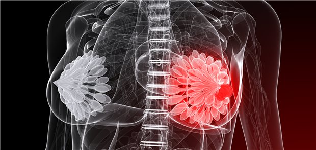 Mammakarzinom: Lässt sich eine neoadjuvante Standardchemotherapie durch Kombination mit onkolytischen Viren bei Frauen mit invasivem triple-negativem Mammakarzinom verbessern?