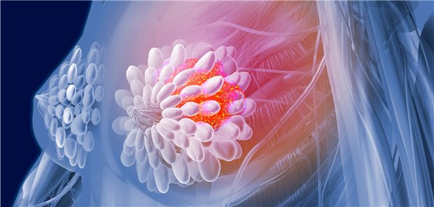 Mammakarzinom: Von einer fünfjährigen Therapie mit Bisphosphonaten für Patientinnen mit frühem Brustkrebs ist wohl eher Abstand zu nehmen.