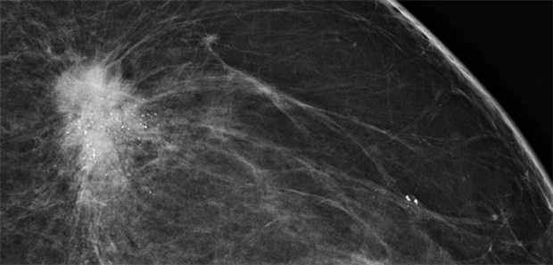Jährliches Screening bereits ab 40? Mammografie: Unregelmäßig begrenzter Tumor im oberen äußeren Quadranten links mit strahligen Ausläufern und Mikrokalk.