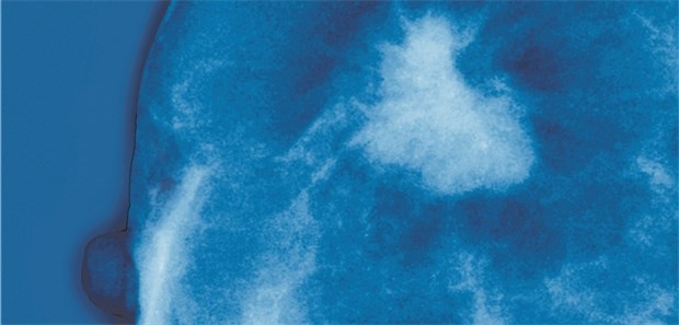 Mammogramm: Bei älteren Frauen mit HER2-positivem metastasiertem Brustkrebs könnte sich eine metronome Chemo lohnen.