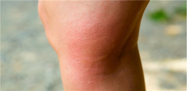 Man weiß um die Bedeutung der Kofaktoren bei sehr schweren oder tödlichen Reaktionen durch Insektengift, die bei rund 70 Prozent der Fälle eine Rolle spielen. Dazu gehören die Einnahme von Medikamenten, körperliche Betätigung vor dem Ereignis sowie Alkohol und Stress.