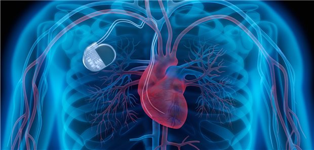 Herzschrittmacher in einem digitalen Bild; Manche Herzschrittmacher und ICD vertragen sich wohl nicht mit einem Mobilfunkgerät, im Text: iPhone 12. Es gibt neue Hinweise darauf, dass es zu Funktionsstörungen der medizinischen Geräte kommen kann.