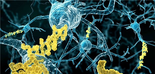 Manche Menschen haben das Gehirn voller -Amyloid, ohne große kognitive Probleme zu haben.