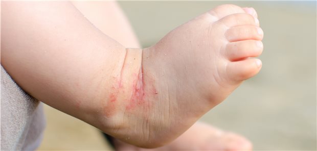 Manifestiert sich eine atopische Dermatitis bereits sehr früh, ist die Wahrscheinlichkeit für einen schweren Verlauf höher.