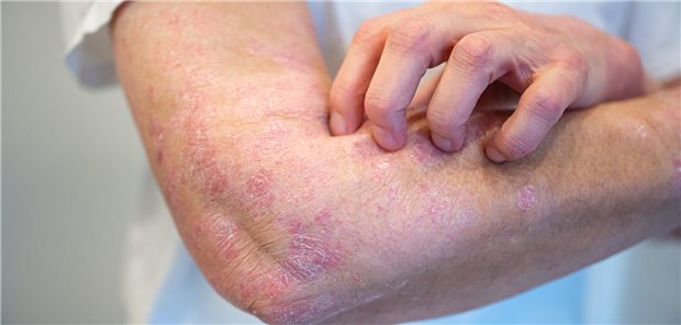 Insgesamt hatten 15,8 Prozent der älteren, aber nur 11,3 Prozent der jüngeren Psoriasiskranken zwischen der Aufnahme in das Register und dem Survey schon einmal eine Biologikatherapie aufgrund von Nebenwirkungen abgebrochen. Bezogen auf 1.000 Behandlungsjahre ergab sich eine nebenwirkungsbedingte Abbruchrate (treatment-ending adverse event, TEAE) von 32,9 versus 23,2. Die Abbruchrate war bei den Älteren damit relativ betrachtet um 42 Prozent höher.