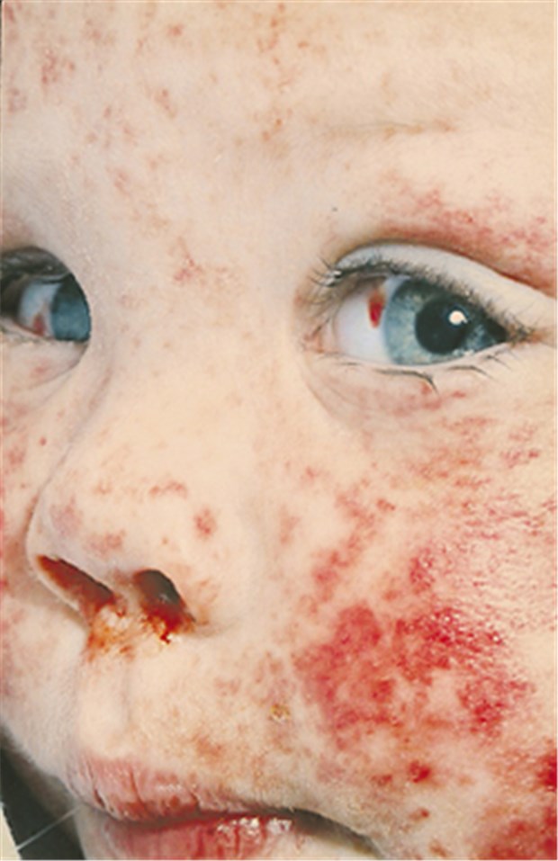 WHO verlangt mehr Engagement gegen Masern Masern bei Kindern sind alles andere als harmlos. Immer wieder sind auch Klinikaufenthalte nötig.