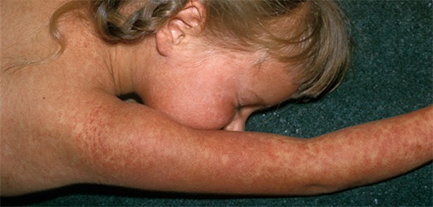 Masern-Ziel schon jetzt verfehlt Masernkrankes Kind: Fehlender Impfschutz ist in Deutschland ein drängendes Problem.