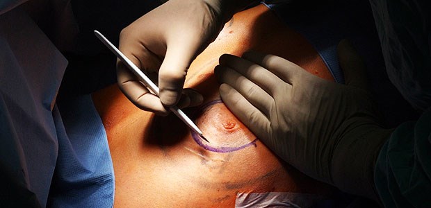 Gentest meist auf Kassenkosten Mastektomie: Etwa zehn Prozent der Frauen mit Brustkrebs haben eine prädisponierende Mutation.