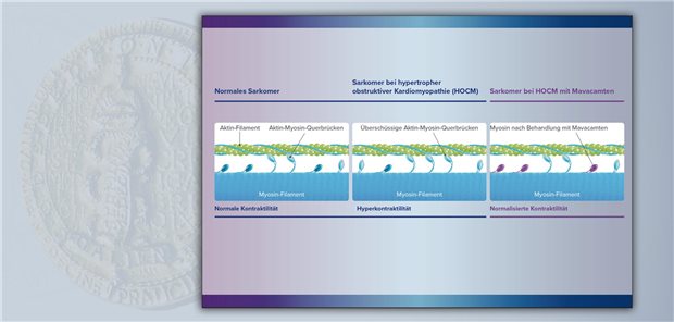 Mavacamten inhibiert selektiv und reversibel das kardiale Myosin. Dadurch kommt es bei der HOCM zur Abnahme überschüssiger Aktin-Myosin-Querverbindungen und die Kontraktilität wird verbessert.