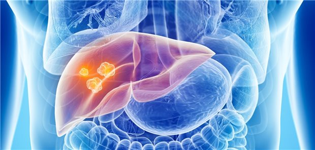 Maximal drei Tumore dürfen Empfänger einer Lebertransplantation gemäß den Mailand-Kriterien haben.