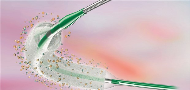 Medikamente-beschichtete Ballonkatheter haben auf der Oberfläche einen antiproliferativen Wirkstoff, der am Ort der Stenose direkt in die Gefäßwand abgegeben.