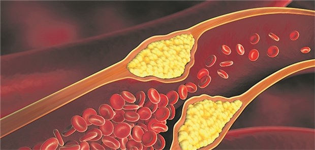 Die klinische Lipidforschung ist tot – oder doch nicht? Medikamentöse Lipid-Therapien sollen atherosklerotische Plaques bekämpfen.