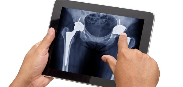 Verpflichtende Zertifizierung beim Einsatz von Endoprothesen gefordert Mehr Qualitätssicherung bei der Implantation von Hüft- und Knieendoprothesen fordert nicht nur der Bundesgesundheitsminister, sondern auch die Fachgesellschaft.