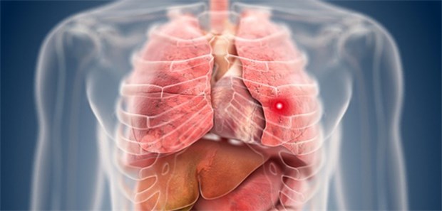 Mehr als 65 Prozent der Menschen, bei denen ein Lungenkarzinom diagnostiziert wird, sind älter als 65 Jahre.