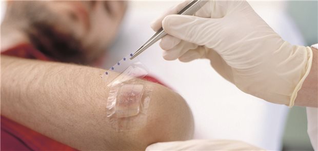 Mehr als ein Verband: Speziell beschichtete Wundauflagen sollen die Heilung fördern. Ob das stimmt, müssen die meisten Hersteller erst noch beweisen, wenn sie im GKV-System bleiben wollen.