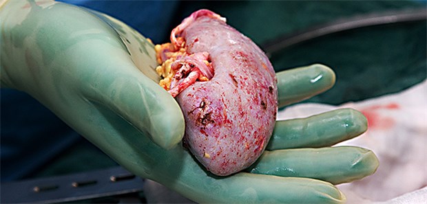 Negativtrend bei Organspenden gebrochen Mehr als jedes zweite transplantierte Organ im Jahr 2018 in Deutschland war eine Niere.