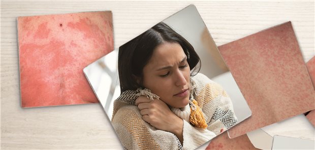Verdacht auf Betalaktam-Allergie: Was tun, wenn die Patientin ein Antibiotikum braucht? Collage von Bildern