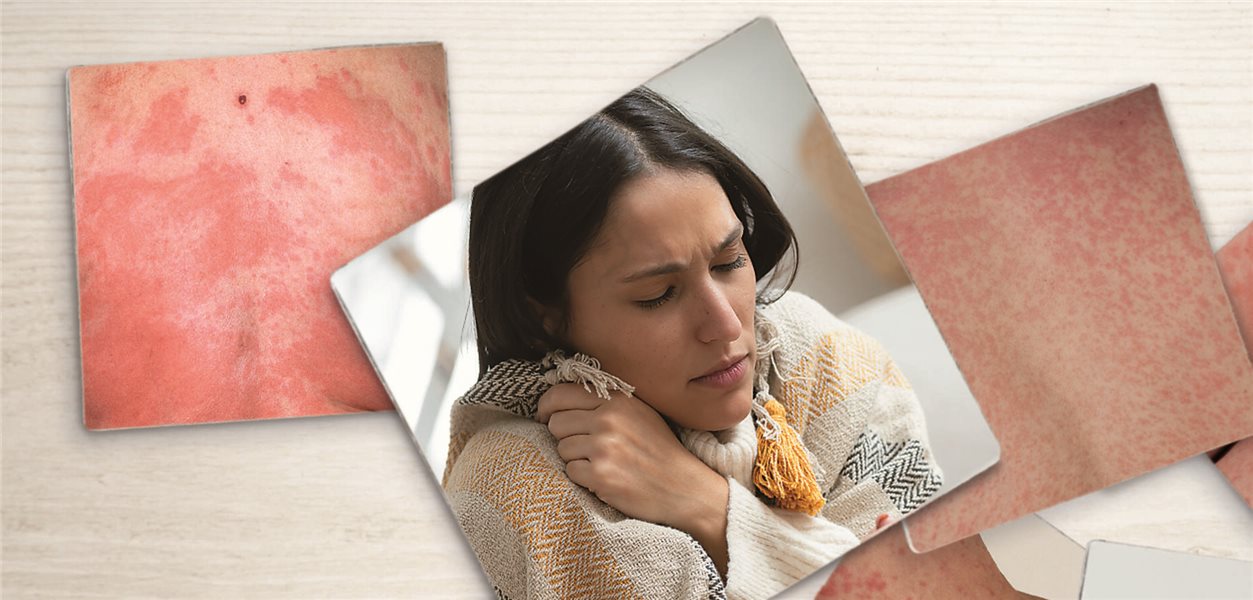 Falsches Label? : Verdacht auf Betalaktam-Allergie: Was tun ...