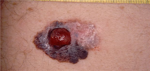 Melanom bei Hauktrebs-Patient im Endstadium