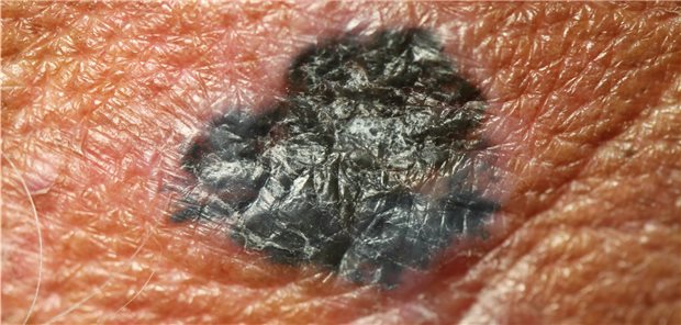 Melanom: Checkpointhemmer haben die Therapie deutlich verbessert, bringen oft aber auch chronische immunbedingte Nebenwirkungen mit sich.