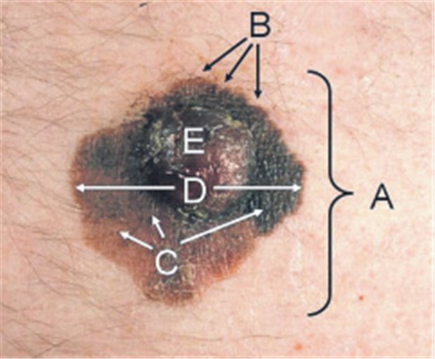 Hautkrebs? Bitte genau hingucken! Melanom-Diagnostik entsprechend der ABCDE-Regel: Asymmetrie, Begrenzung, Colorit, Durchmesser, Erhabenheit/Entwicklung.