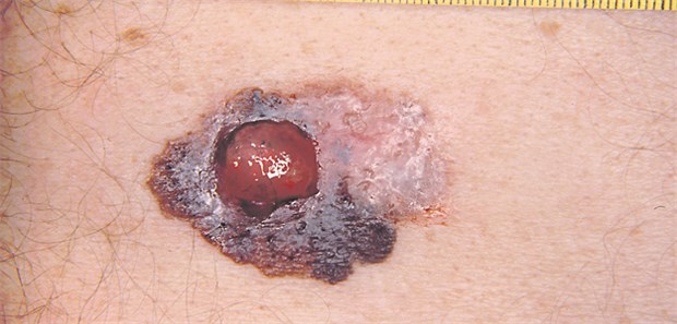Schlechte Prognose bei zu niedrigem Vitamin-D? Melanom: Für ihre Studie untersuchten die Forscher Plasmaproben von über 1000 Patienten.