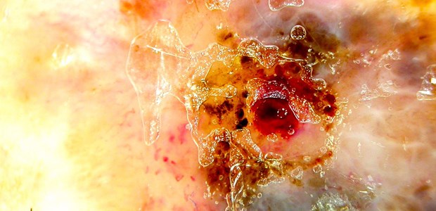 Auf dem Weg zum Multi-Marker-Panel Melanom: Wo geht die Reise hin bei der Diagnostik?