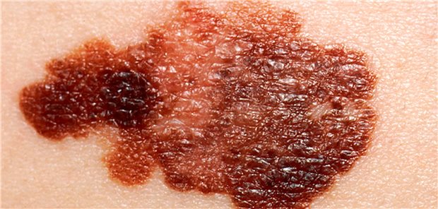 Melanom: Zu Exzision, Diagnose und Staging gibt es klare Vorgaben.