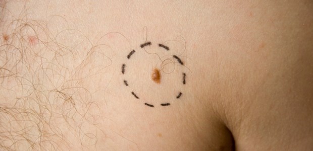 Hausärzte sind Screening-Meister Melanom - immer mehr Diagnosen werden hierzulande gestellt.