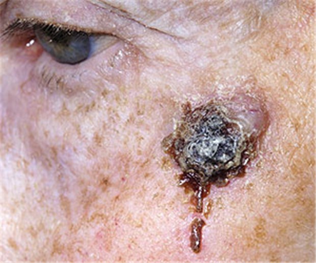 Alte Patienten schlechter versorgt? Melanome fallen bei Älteren meist im Rahmen einer allgemeinmedizinischen Untersuchung auf. Bei Jüngeren hingegen wird die Diagnose überwiegend von Dermatologen gestellt.