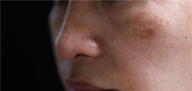 Nahaufnahme einer Frau mit Melasma im Gesicht.