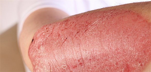 Psoriasis – Saufen gegen den Schuppenfrust? Menschen mit Psoriasis haben ein um 58 Prozent höheres Risiko für einen alkoholbedingten Tod als vergleichbare Altersgenossen ohne diese Hauterkrankung, errechneten jetzt britische Forscher.