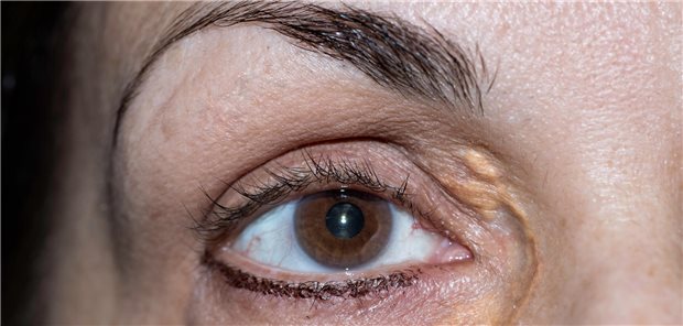 Nahaufnahme der rechten Augenpartie einer Frau mit Xanthelasma palpebrarum.