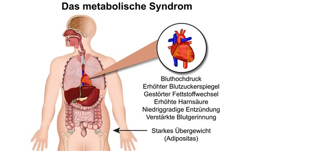 Metabolisches Syndrom: Ein wesentlicher Risikofaktor für kardiale Folgeerkrankungen ist Bluthochdruck, wie eine Studie bestätigt.