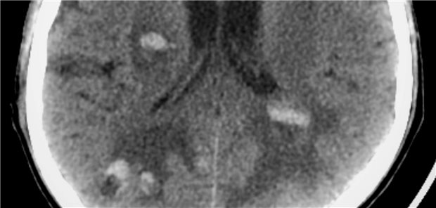 Metastasen im Hirn, hier hämorrhagische Metastasen in einer CT-Aufnahme.