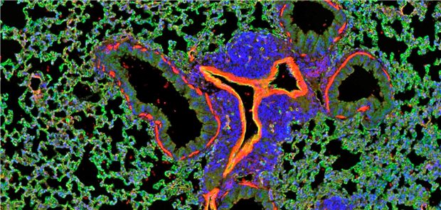 Metastasenwachstum im Mausmodell: Tumorzellen (blau) breiten sich um Blutgefäße der Lunge (rot) aus und verdrängen das Lungengewebe (grün).