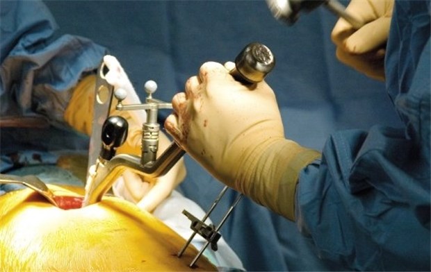 Minimal-invasive Hüft-Op schont Muskeln MicroHip mit Navigation erlaubt es, das Implantat gut zu positionieren.